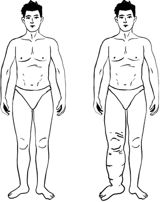 medici chirurgia cardiovascolare milano Chirurgo Vascolare Angiologo Dott.ssa Luisella Troyer - Cura del Linfedema e del Lipedema