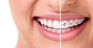ortodonzia invisibie invisalign dentista milano San Gottardo