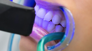 sbiancamento dei denti milano Dott.ssa Francesca Marasco igienista dentale